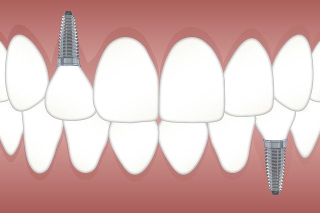 ukázka zubního implantátu